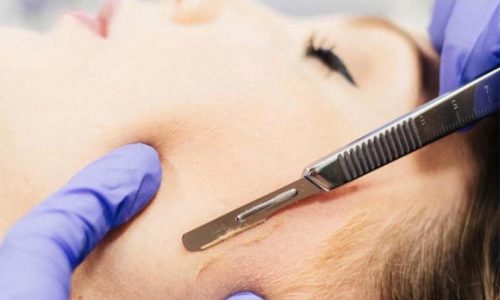 Dermaplaning